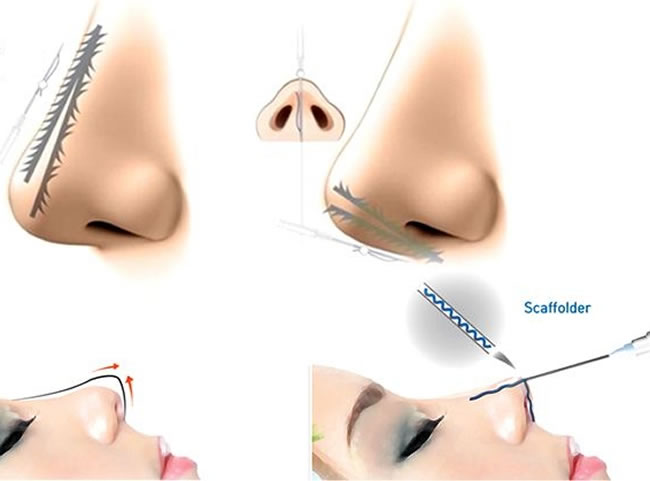 Phương pháp nâng mũi bằng chỉ collagen