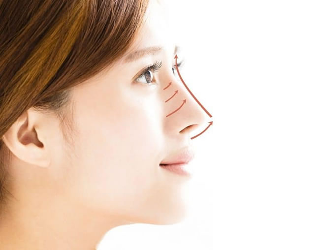 Nâng mũi bằng chỉ collagen giúp bạn có dáng mũi cao hơn, đẹp hơn